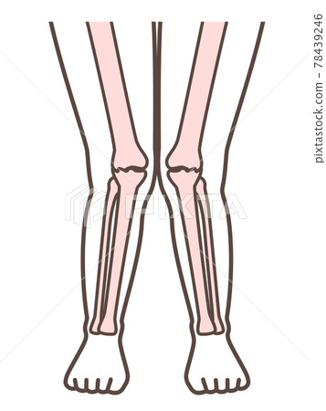 解釋 X 腿和膝蓋疾病的插圖 78439246