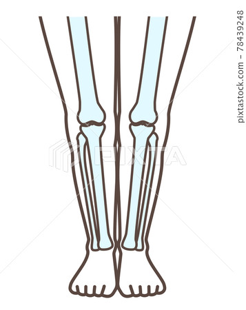 解釋正常腳和膝蓋疾病的插圖 解釋正常腳和膝蓋疾病的插圖 78439248