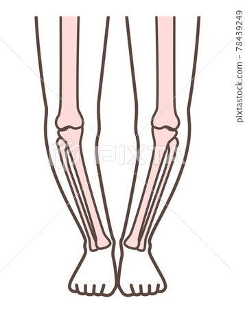O-legged legs, illustrations for explaining diseases of the legs and knees O-legged legs, illustrations for explaining diseases of the legs and knees 78439249