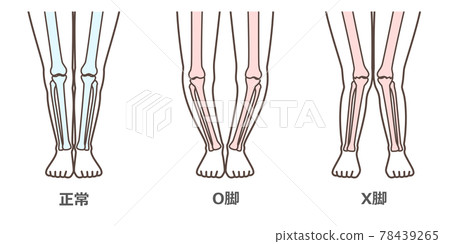 膝關節骨關節炎圖示 78439265