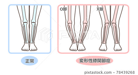 膝關節骨關節炎圖示 78439268