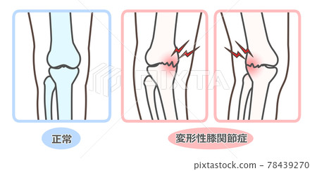 膝關節骨關節炎圖示 78439270