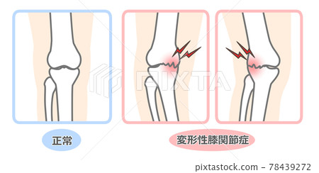 Knee osteoarthritis illustrated 78439272
