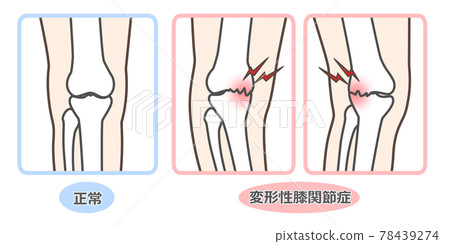 膝關節骨關節炎圖示 78439274