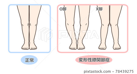 膝關節骨關節炎圖示 78439275