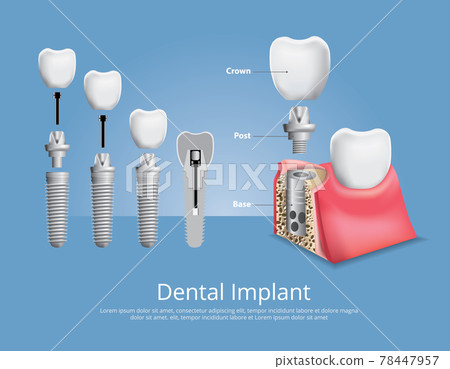 Human teeth Stages of Gum Disease Vector Illustration 78447957