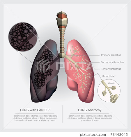 Lung with Detail and Lung Cancer Vector Illustration Lung with Detail and Lung Cancer Vector Illustration 78448045