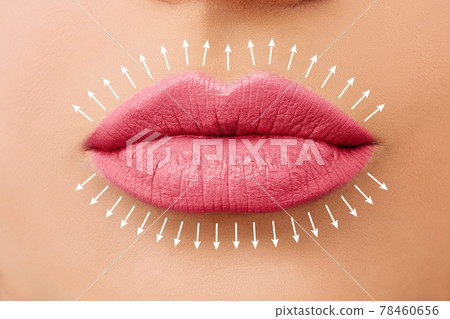 Lip augmentation. Fillers. Beautiful perfect pink lips Lip augmentation. Fillers. Beautiful perfect pink lips 78460656