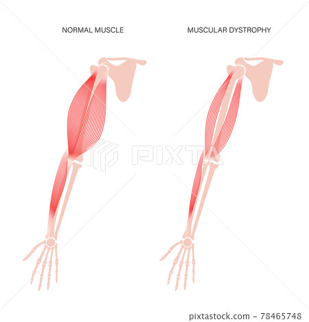 Muscular dystrophy of arm 78465748