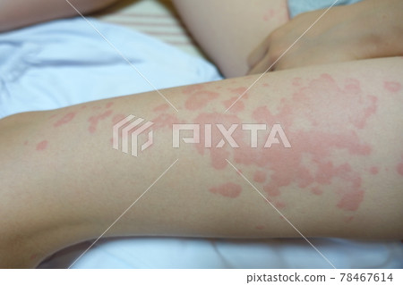 Urticaria, urticaria, eczema 78467614