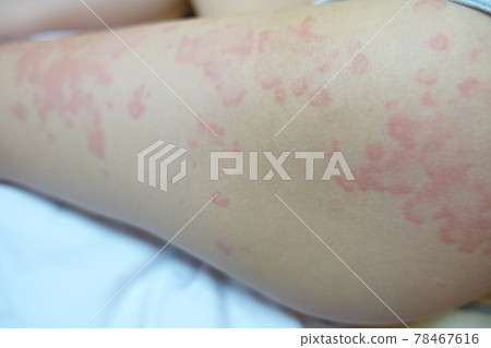Urticaria, urticaria, eczema Urticaria, urticaria, eczema 78467616