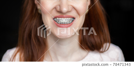 The smile of a young girl with braces on her white teeth. The smile of a young girl with braces on her white teeth. 78471343