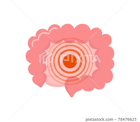 Bowel pain. Unhealthy small and large human intestine. Bowel diseases - SIBO, leaky gut syndrome, cancer or candida growth. Abstract intestine. Vector illustration isolated on white background Bowel pain. Unhealthy small and large human intestine. Bowel diseases - SIBO, leaky gut syndrome, cancer or candida growth. Abstract intestine. Vector illustration isolated on white background 78476625