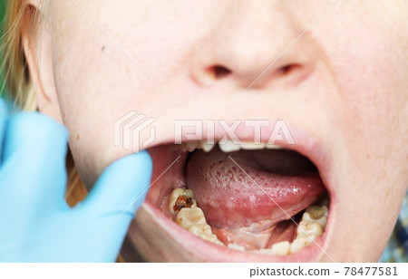 Deep caries, open canals, cleaning canals. Patient at stomatolon on admission, periodontitis treatment Deep caries, open canals, cleaning canals. Patient at stomatolon on admission, periodontitis treatment 78477581