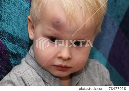 A big bruise on the forehead of a little boy A big bruise on the forehead of a little boy 78477938