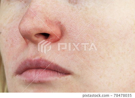Cuperosis on the nose of a young woman. Acne on the face. Examination by a doctor 78478035