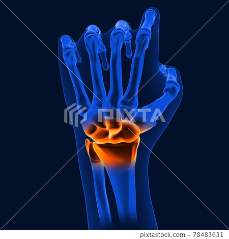 3D_Illustration_wrist_painful_human_skeleton_medical_concept 78483631