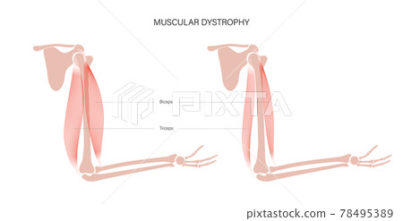 Muscular dystrophy of arm 78495389