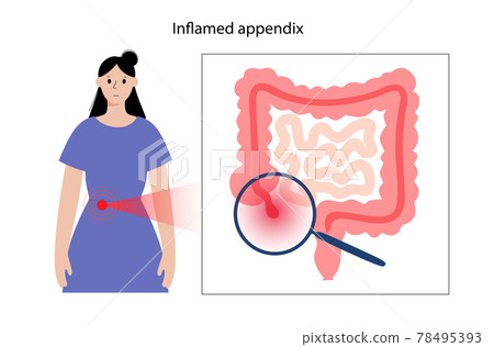 Appendix pain concept 78495393