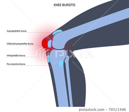 Bursitis inflammation concept 78521496