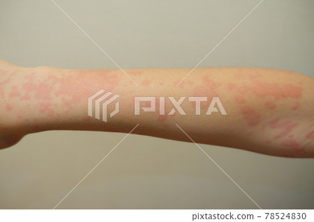 Urticaria, urticaria, eczema Urticaria, urticaria, eczema 78524830