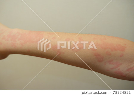 Urticaria, urticaria, eczema 78524831