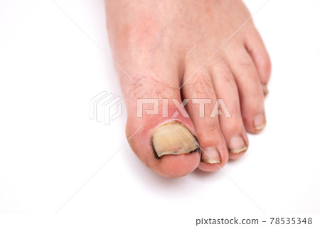 Inflamed and broken toenail on white background. Inflamed and broken toenail on white background. 78535348