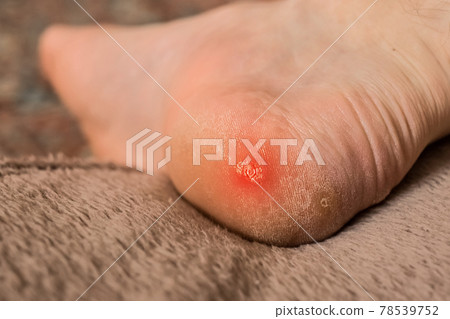 Dry mazole on a cracked heel male. Man's leg with corns, close up Dry mazole on a cracked heel male. Man's leg with corns, close up 78539752