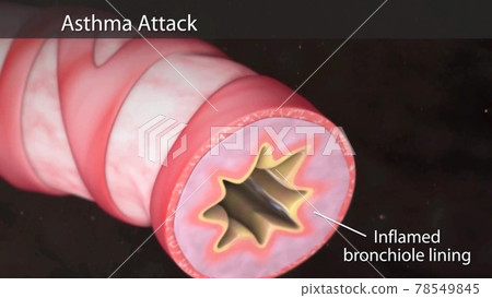 Asthma atack illustration Human lungs with bronchi of mesh of model. Looping motion animated 3d model. 78549845
