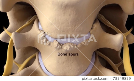 Spinal Stenosis as a degenerative illness in the human vertebrae causing compressed spine nerves medical concept as a 3D illustration. Spinal Stenosis as a degenerative illness in the human vertebrae causing compressed spine nerves medical concept as a 3D illustration. 78549859