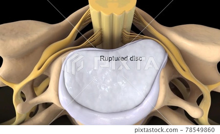 Spinal Stenosis as a degenerative illness in the human vertebrae causing compressed spine nerves medical concept as a 3D illustration. Spinal Stenosis as a degenerative illness in the human vertebrae causing compressed spine nerves medical concept as a 3D illustration. 78549860