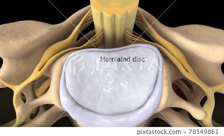 Spinal Stenosis as a degenerative illness in the human vertebrae causing compressed spine nerves medical concept as a 3D illustration. Spinal Stenosis as a degenerative illness in the human vertebrae causing compressed spine nerves medical concept as a 3D illustration. 78549861