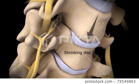 Spinal Stenosis as a degenerative illness in the human vertebrae causing compressed spine nerves medical concept as a 3D illustration. 78549863
