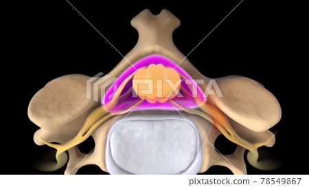 Spinal Stenosis as a degenerative illness in the human vertebrae causing compressed spine nerves medical concept as a 3D illustration. Spinal Stenosis as a degenerative illness in the human vertebrae causing compressed spine nerves medical concept as a 3D illustration. 78549867
