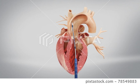 Aortic prosthesis surgery attachment of artificial prosthetic aortic valve to heart in animated human model 78549883