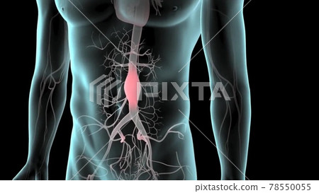 Abdominal aortic aneurysm. Arterial circulatory system of the abdominal. Healthy abdominal aorta and abdominal aorta with aneurysm. illustration in flat style isolated on black background Abdominal aortic aneurysm. Arterial circulatory system of the abdominal. Healthy abdominal aorta and abdominal aorta with aneurysm. illustration in flat style isolated on black background 78550055