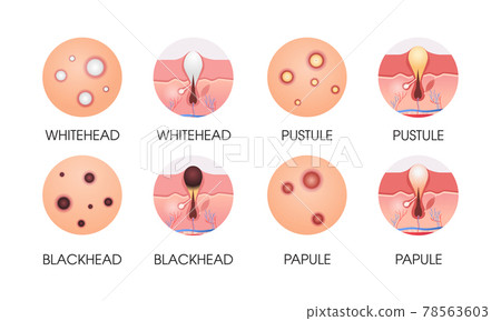 Pimples Diagram Acne And How It Affects Our Confidence Verve Clinic
