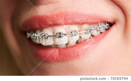 Female smile with metal braces on white teeth. 78569794