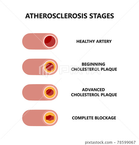 Stages of atherosclerosis. Cholesterol plaque formation and growth. Stages of atherosclerosis. Cholesterol plaque formation and growth. 78599067