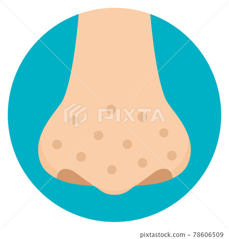 Illustration of dirty nose, freckles, strawberry nose, crater, acne scars, flat design Illustration of dirty nose, freckles, strawberry nose, crater, acne scars, flat design 78606509