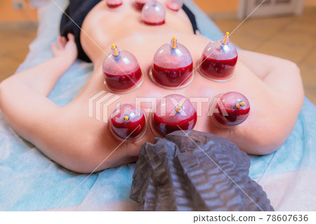 A hijama master performs a vacuum blood suction procedure for a young girl. A hijama master performs a vacuum blood suction procedure for a young girl. 78607636