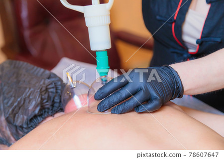 A hijama master performs a vacuum blood suction procedure for a young girl. A hijama master performs a vacuum blood suction procedure for a young girl. 78607647