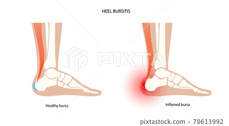 Bursitis inflammation concept 78613992