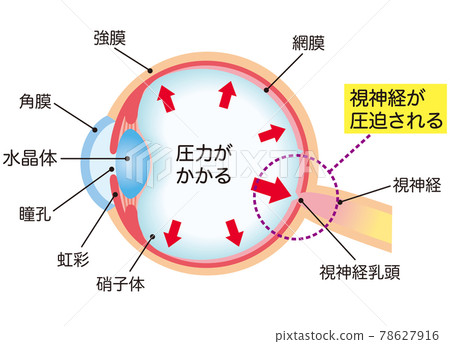 Structure of glaucoma cross section 78627916