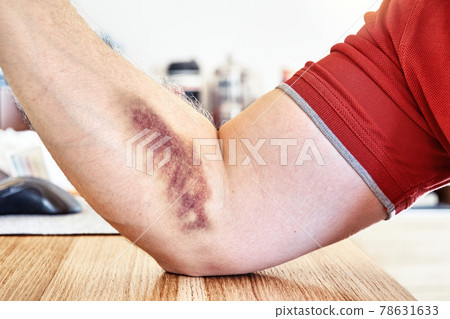 Man shows bruise from vein injection on forearm at table 78631633