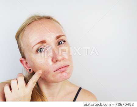 Oily and problem skin. Portrait of a blonde girl with acne, oily skin and pigmentation Oily and problem skin. Portrait of a blonde girl with acne, oily skin and pigmentation 78670498