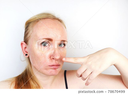 Oily and problem skin. Portrait of a blonde girl with acne, oily skin and pigmentation Oily and problem skin. Portrait of a blonde girl with acne, oily skin and pigmentation 78670499