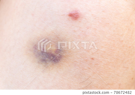 Closed up background of violet lesion on asian woman skin Closed up background of violet lesion on asian woman skin 78672482