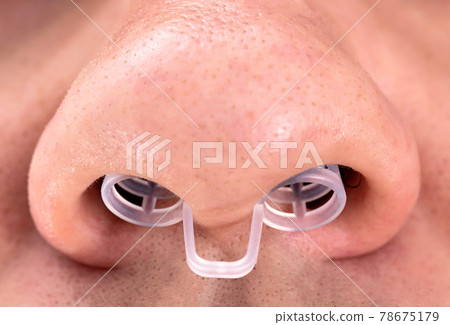 A device against snoring in a person's nose, close-up, macro. Sleep problems A device against snoring in a person's nose, close-up, macro. Sleep problems 78675179