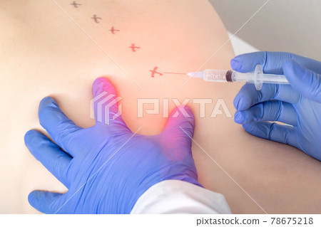 medical spinal block for the treatment of intervertebral disc herniation and protrusion. Concept of a modern treatment for pain relief, blockade therapy medical spinal block for the treatment of intervertebral disc herniation and protrusion. Concept of a modern treatment for pain relief, blockade therapy 78675218